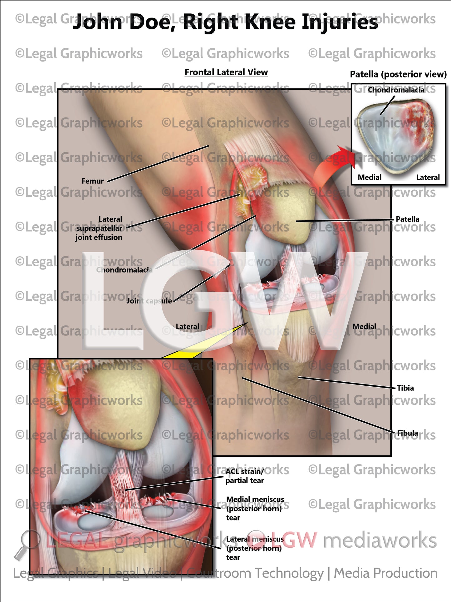 Right Knee Injuries