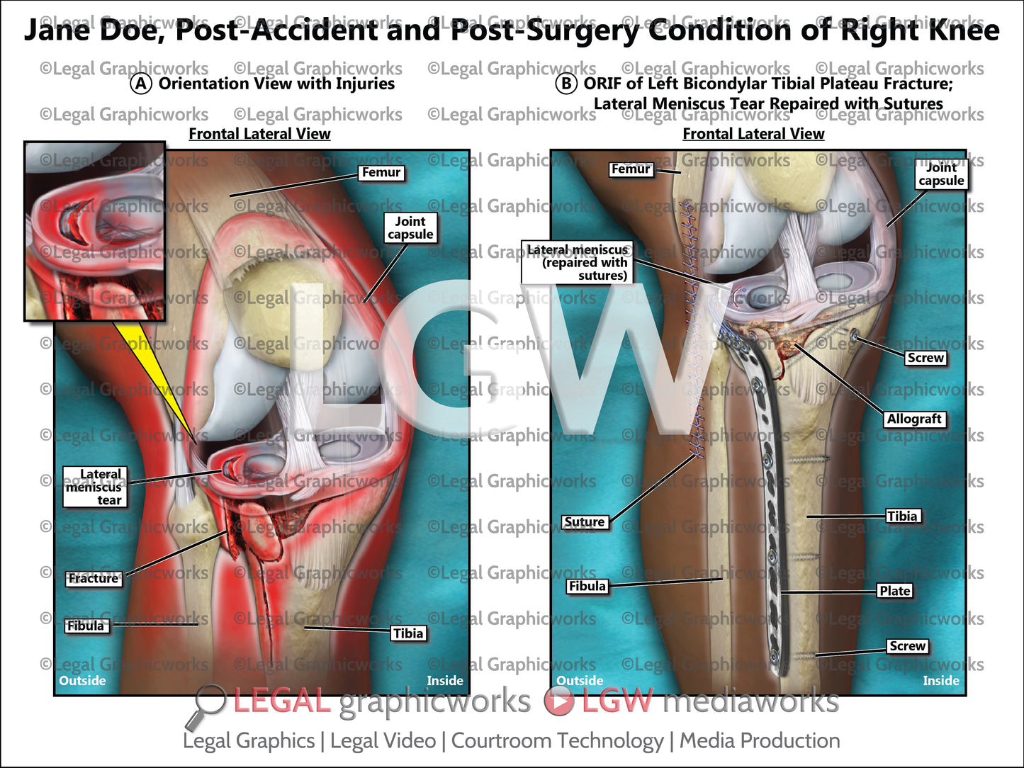 Post-Accident and Post-Surgery Condition of Right Knee