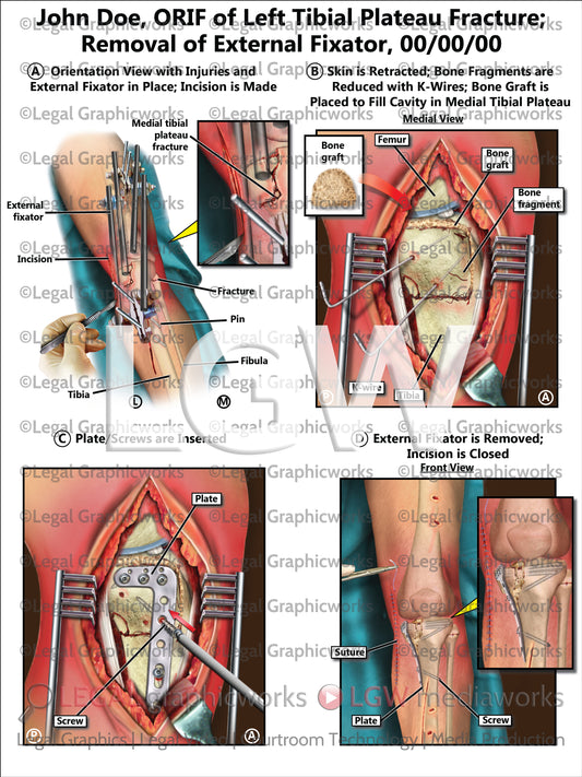 ORIF of Left Tibial Plateau Fracture; Removal of External Fixator