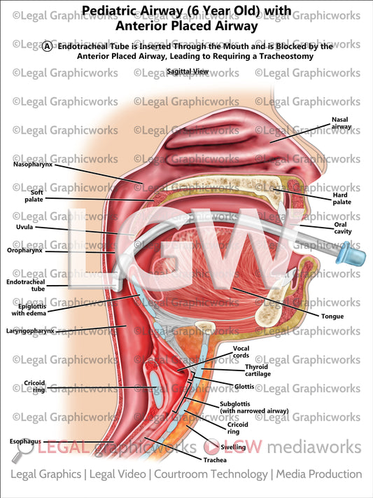 Pediatric Airway (6 Year Old) with Anterior Placed Airway