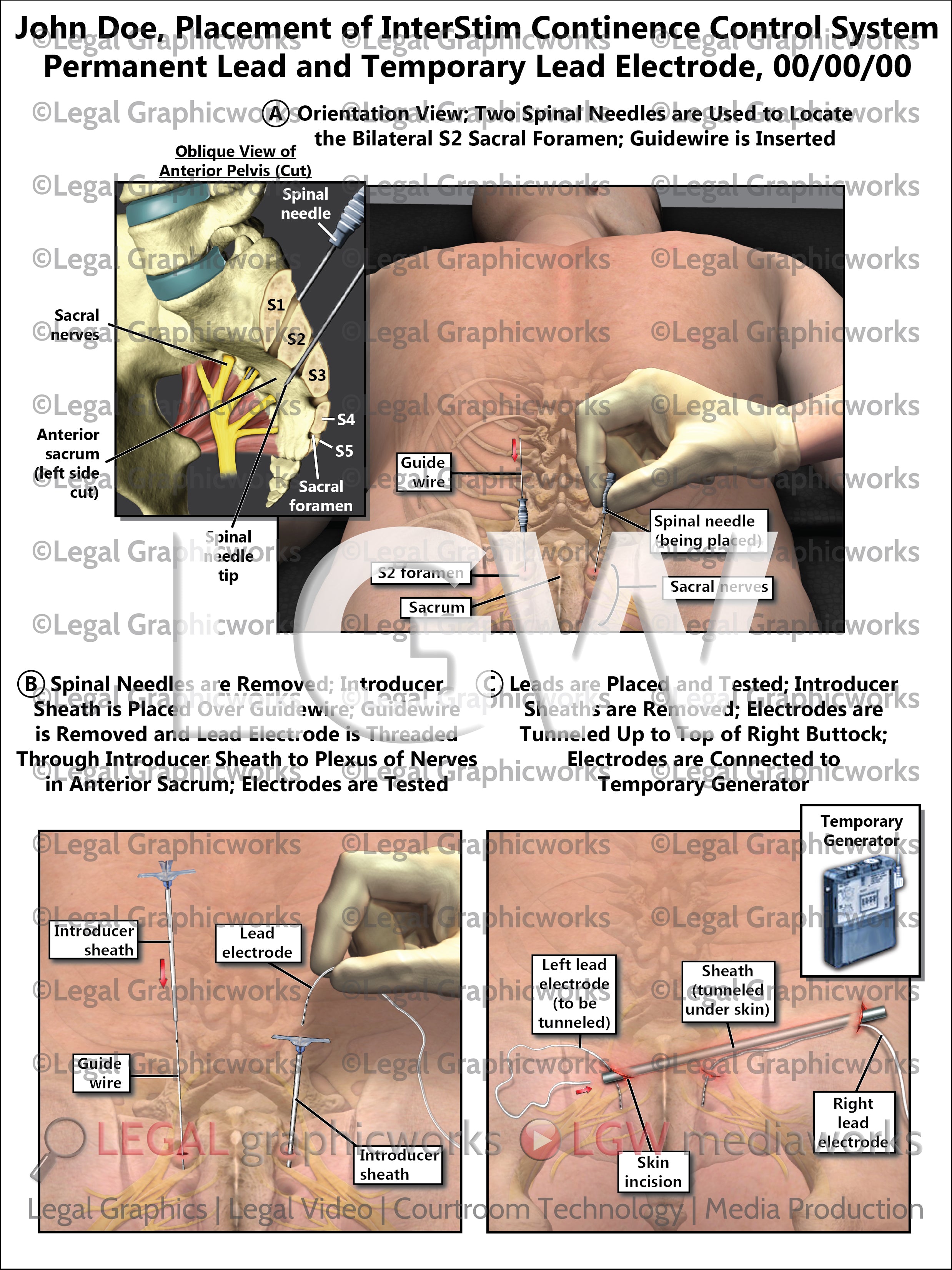Interstim Form Placement of InterStim Continence Control System Permanent Lead and Te ...