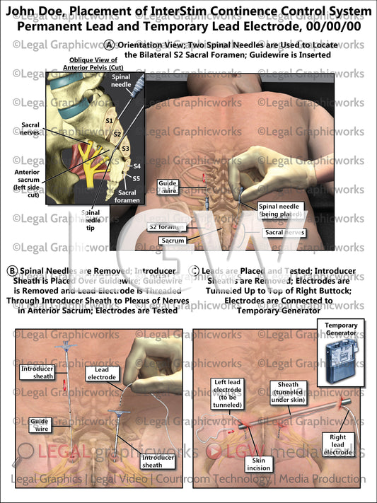 Placement of InterStim Continence Control System Permanent Lead and Temporary Lead Electrode