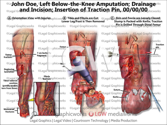 Left Below-the-Knee Amputation; Drainage and Incision; Insertion of Traction Pin