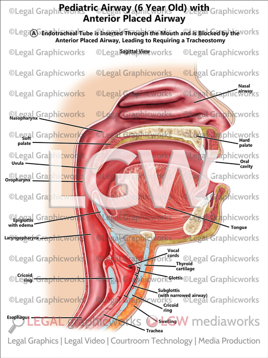 Pediatric Airway (6 Year Old) with Anterior Placed Airway