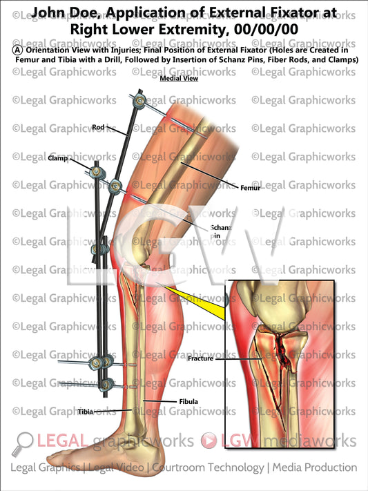 Application of External Fixator at Right Lower Extremity