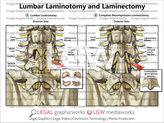 Lumbar Laminotomy and Laminectomy
