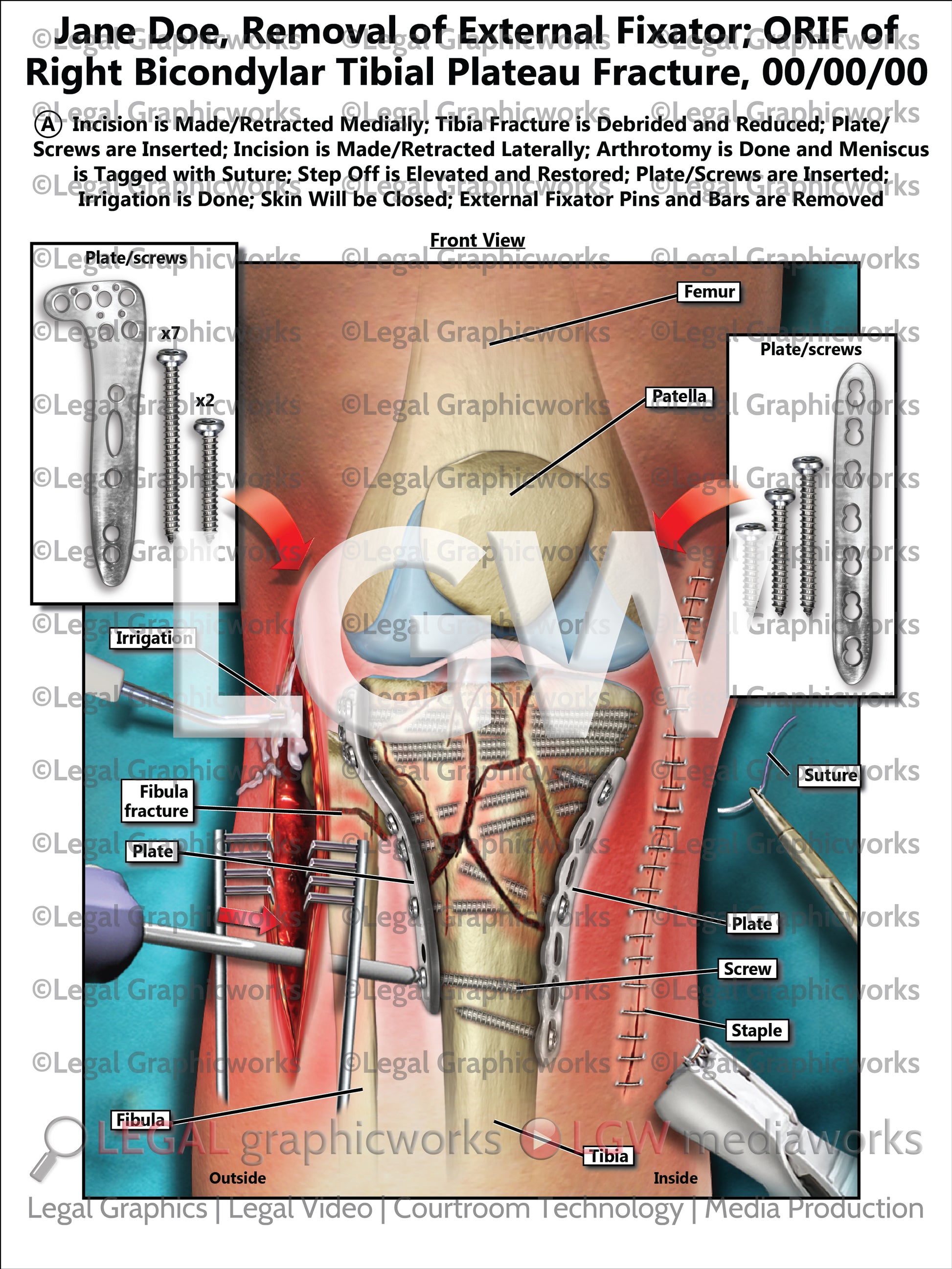 External Fixation Open Tibia Removal of External Fixator; ORIF of Right Bicondylar Tibial Plateau F ...