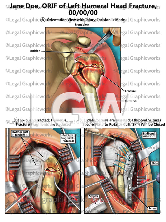 ORIF of Left Humeral Head Fracture