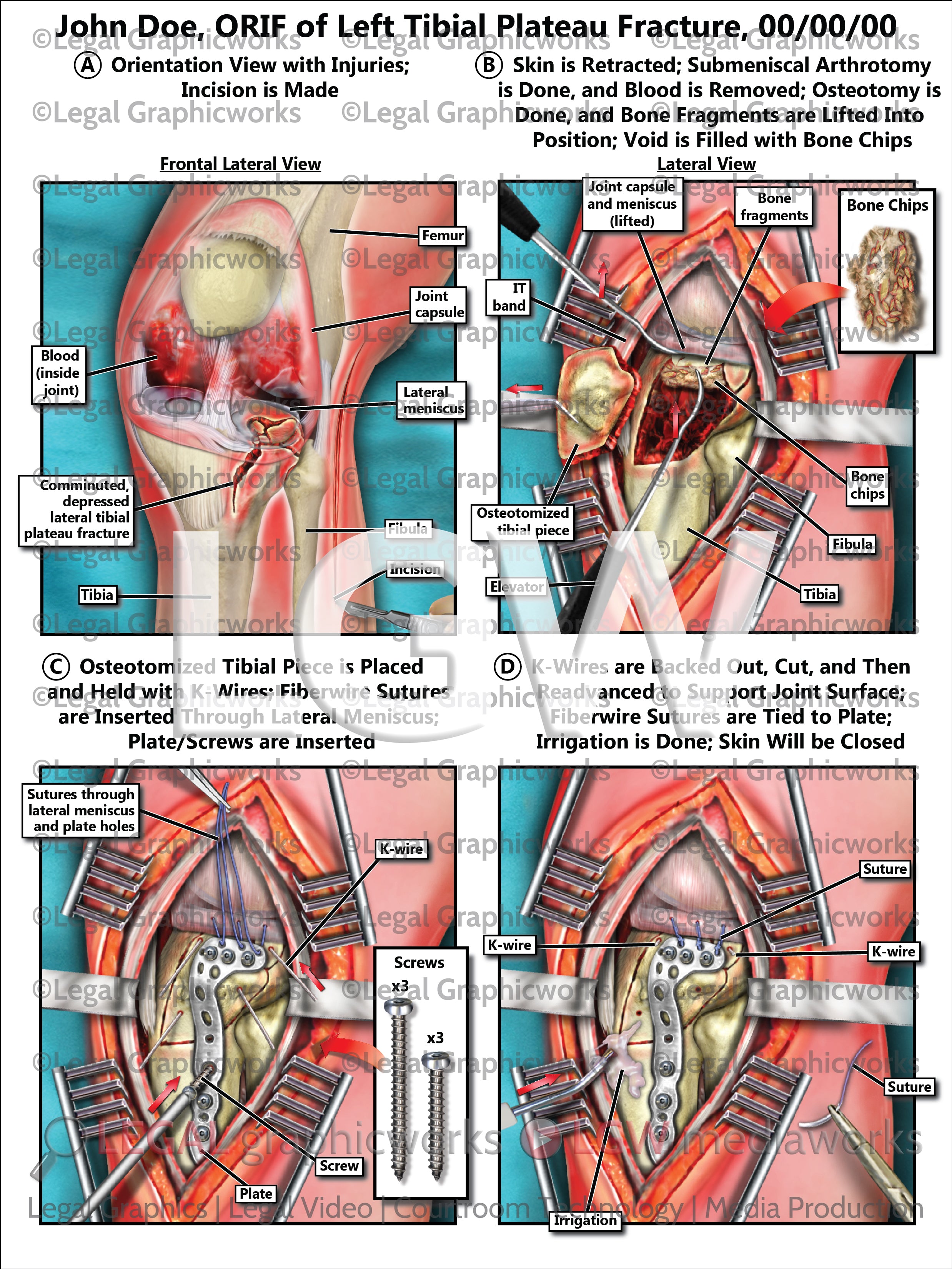 ORIF of Left Tibial Plateau Fracture – LGWgo