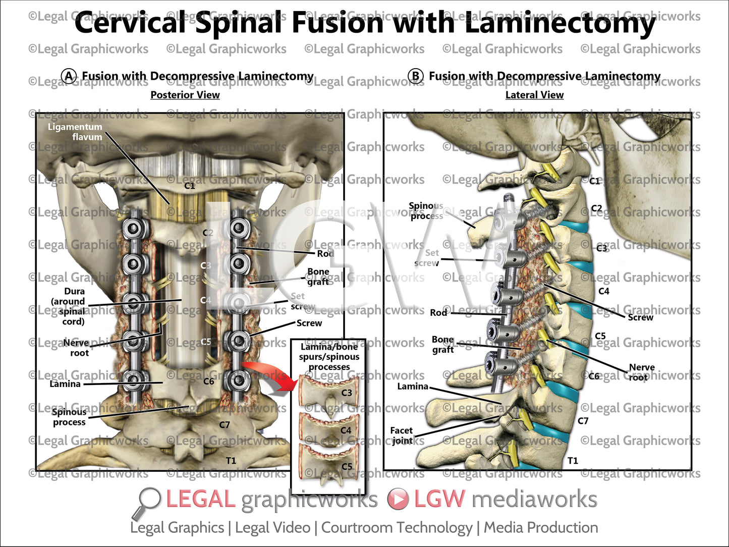 Cervical Spinal Fusion with Laminectomy
