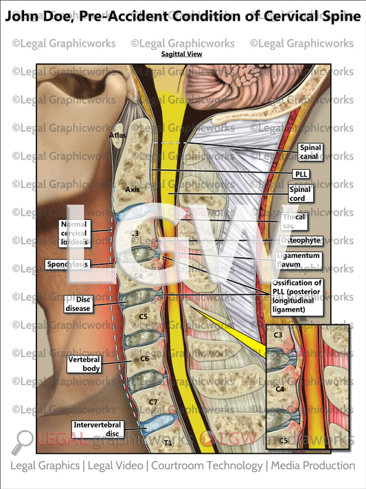 Pre-Accident Condition of Cervical Spine