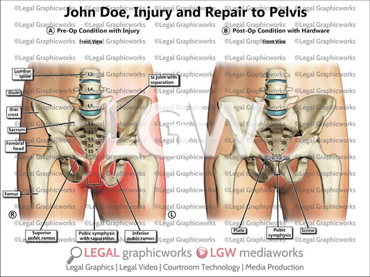 Injury and Repair to Pelvis