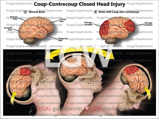 Coup-Contrecoup Closed Head Injury