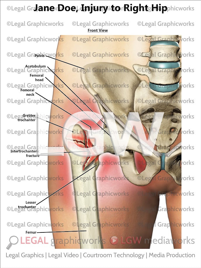 Injury to Right Hip
