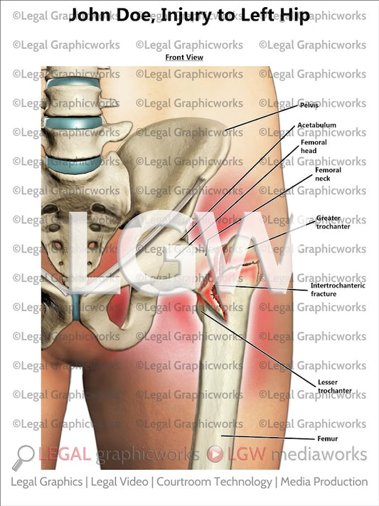 Injury to Left Hip