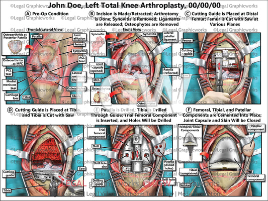 Left Total Knee Arthroplasty