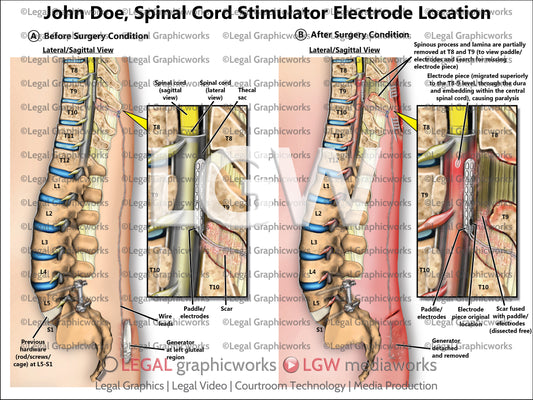 Spinal Cord Stimulator Electrode Location