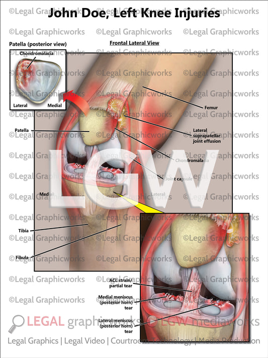 Left Knee Injuries
