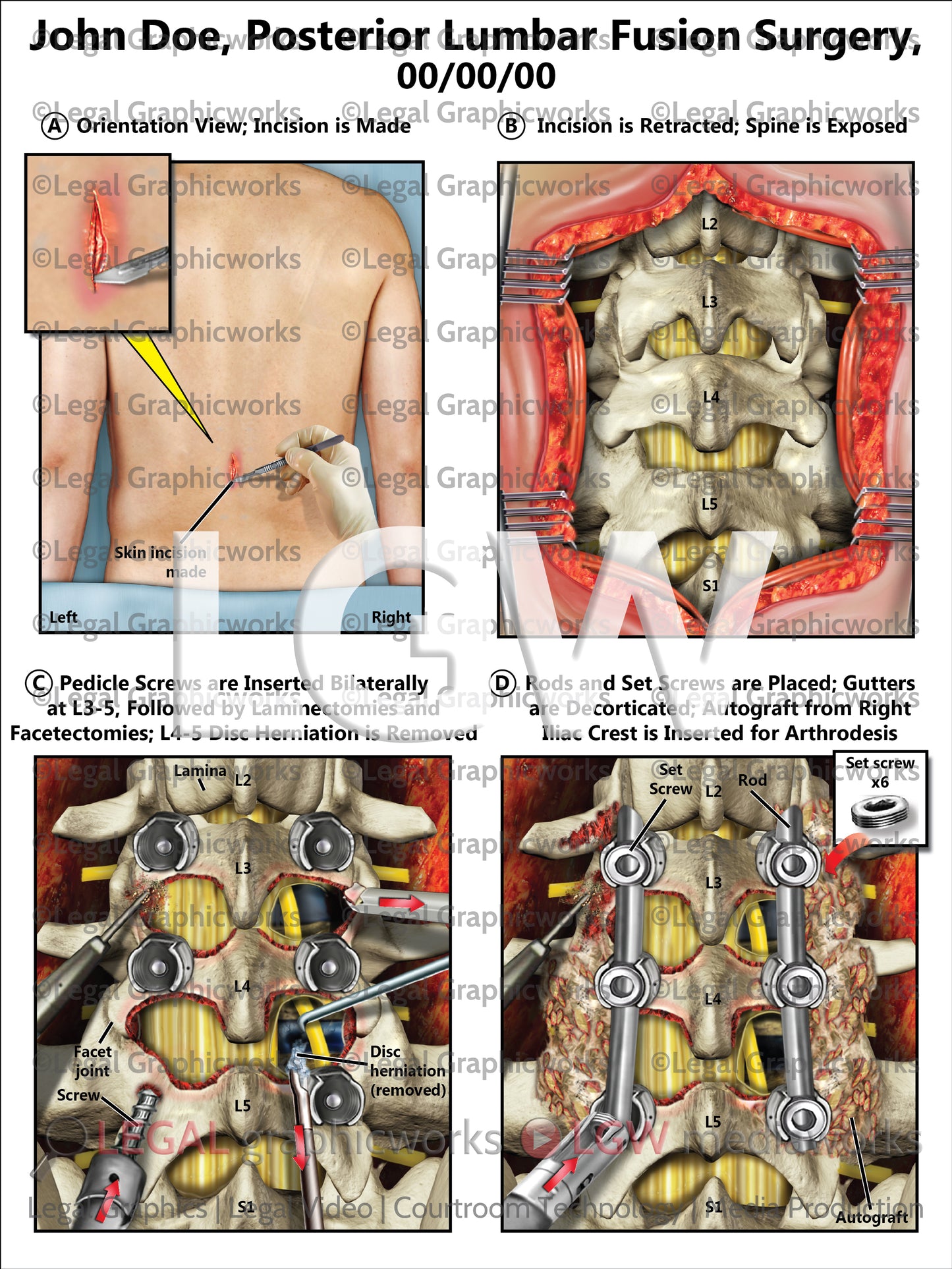 Posterior Lumbar Fusion Surgery