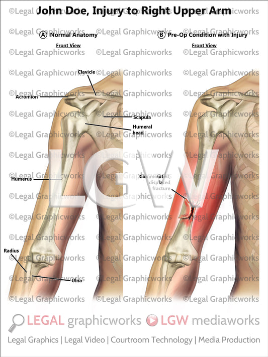 Injury to Right Upper Arm