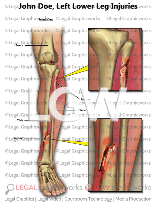 Left Lower Leg Injuries