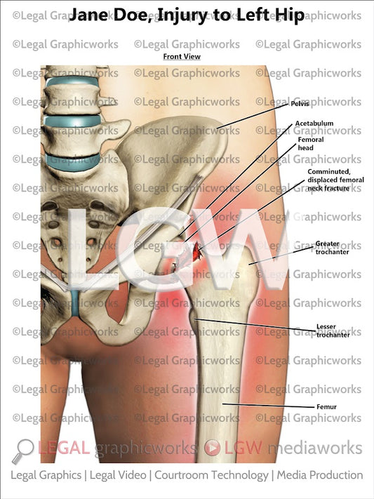 Injury to Left Hip