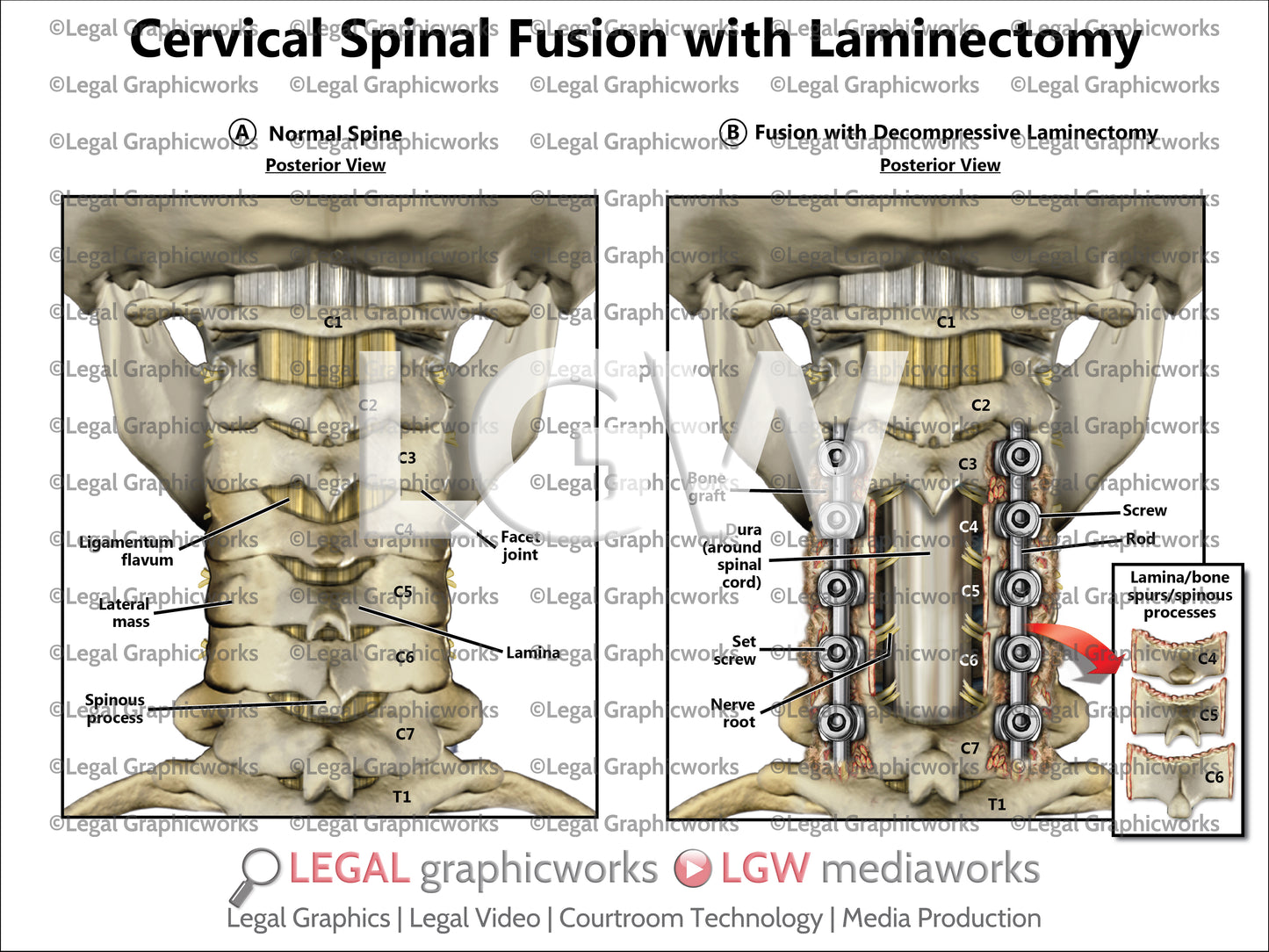Cervical Spinal Fusion with Laminectomy