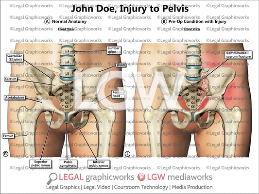 Injury to Pelvis