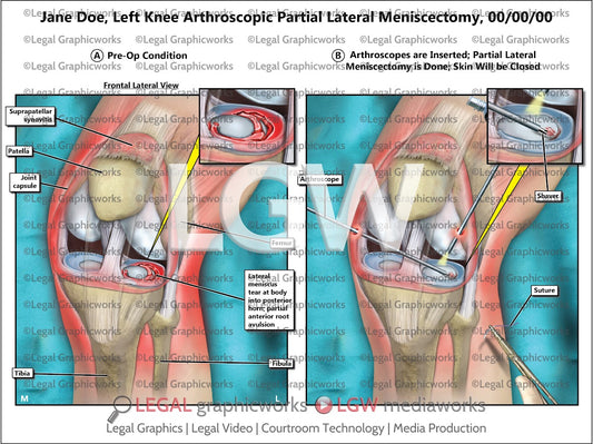 Left Knee Arthroscopic Partial Lateral Meniscectomy