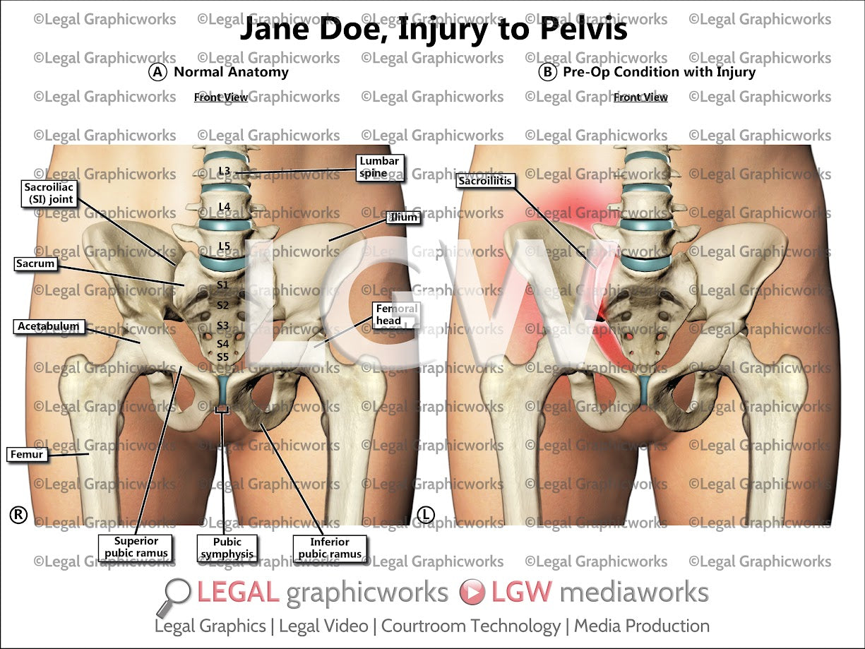 Injury to Pelvis