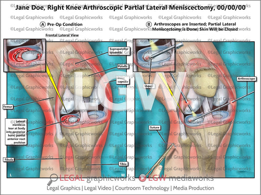 Right Knee Arthroscopic Partial Lateral Meniscectomy