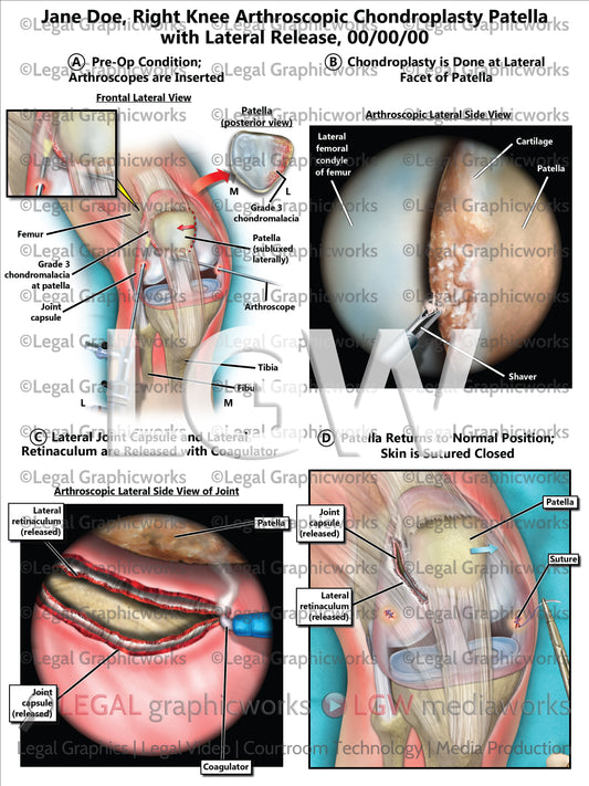 Right Knee Arthroscopic Chondroplasty Patella with Lateral Release