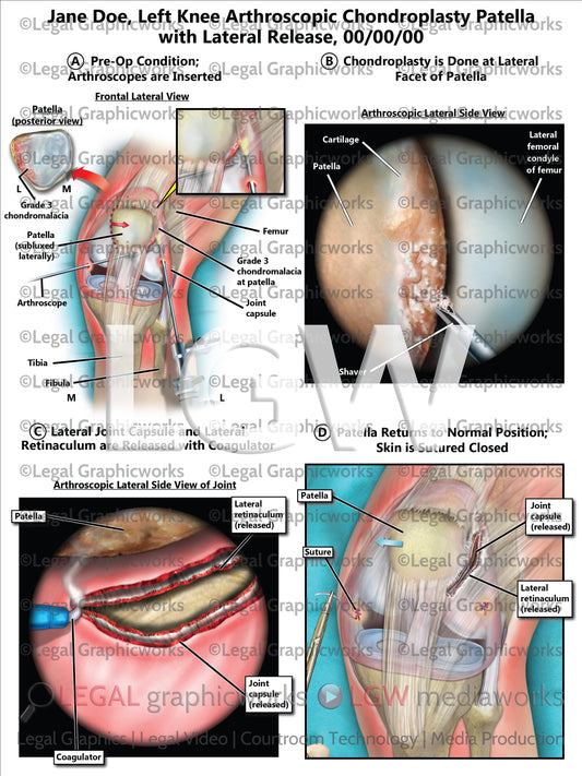 Left Knee Arthroscopic Chondroplasty Patella with Lateral Release