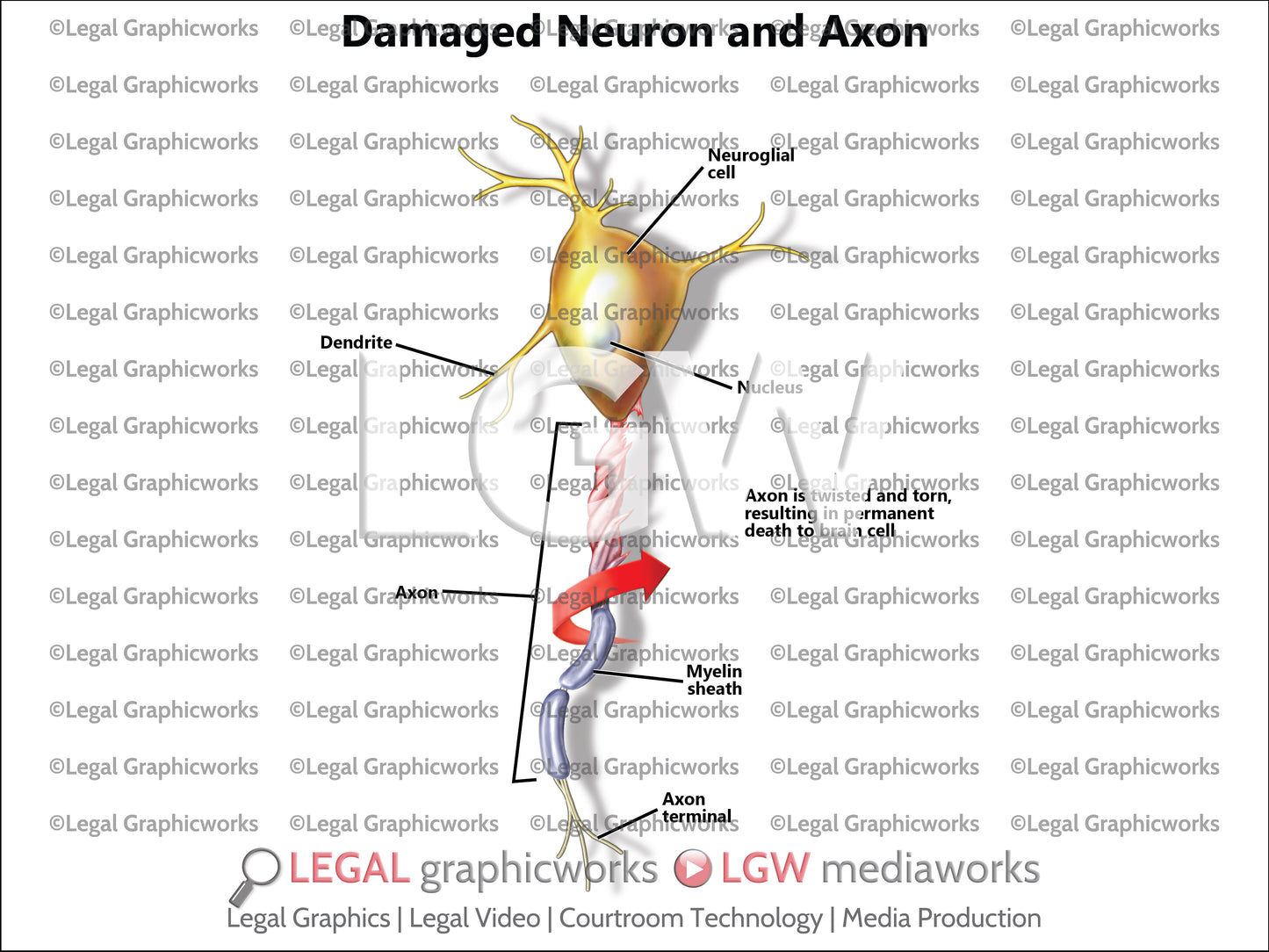 Damaged Neuron and Axon