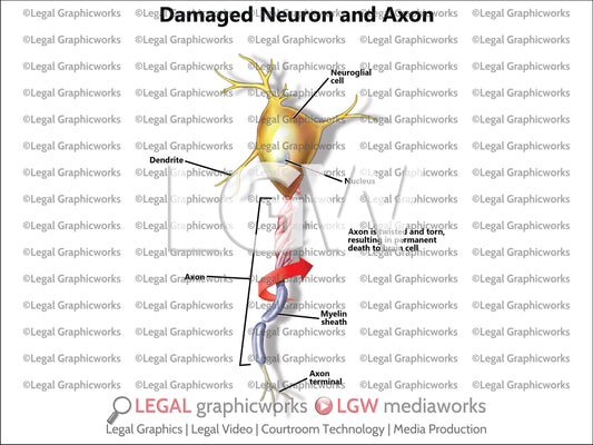 Damaged Neuron and Axon