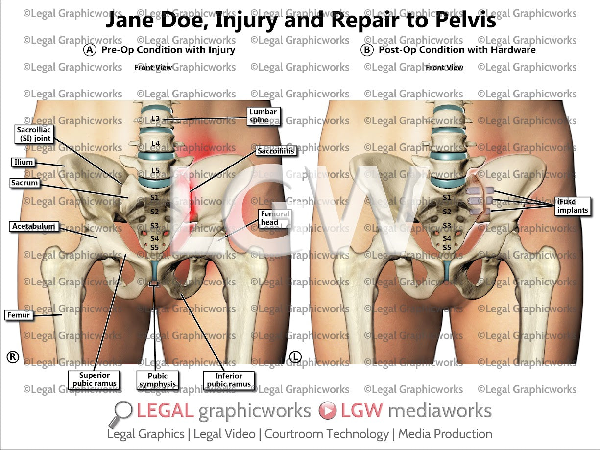 Injury and Repair to Pelvis