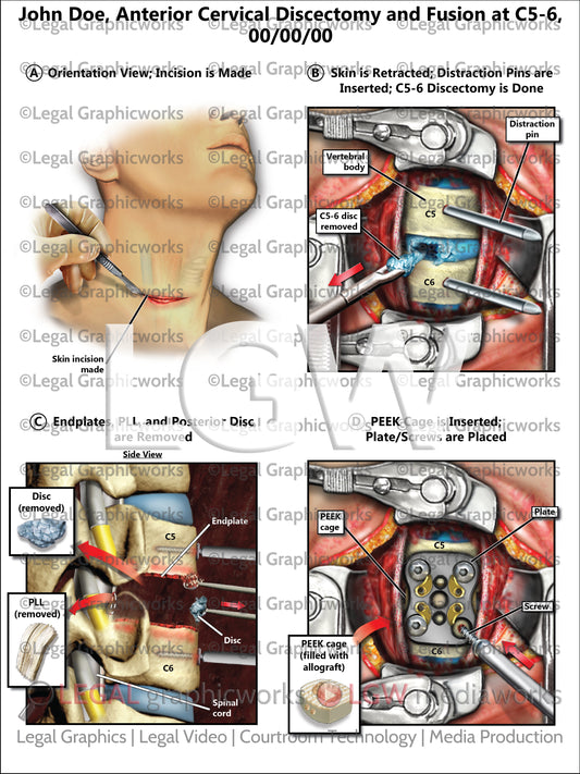 Anterior Cervical Discectomy and Fusion at C5-6