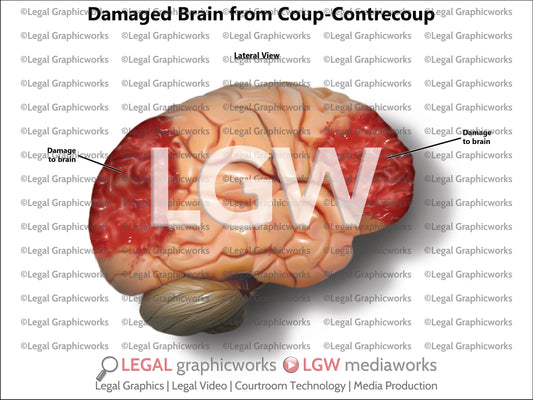 Damaged Brain from Coup-Contrecoup