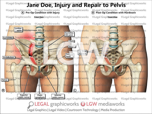Injury and Repair to Pelvis