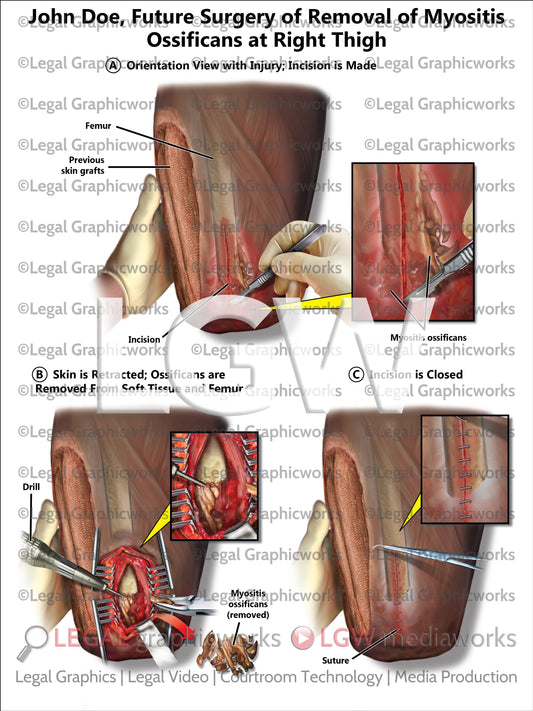 Future Surgery of Removal of Myositis Ossificans at Right Thigh