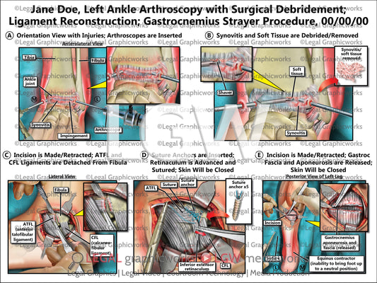 Left Ankle Arthroscopy with Surgical Debridement; Ligament Reconstruction; Gastrocnemius Strayer Procedure