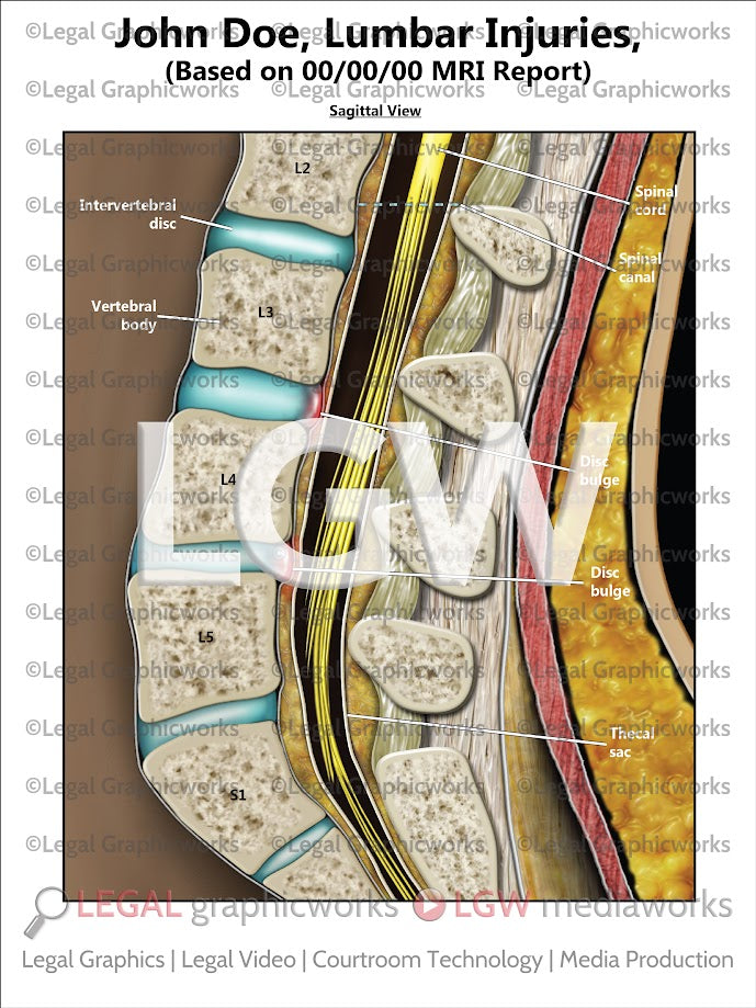 Lumbar Injuries