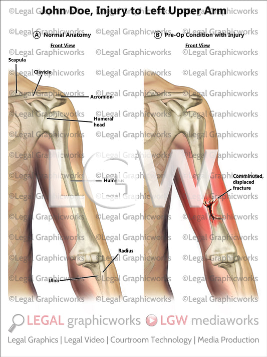 Injury to Left Upper Arm