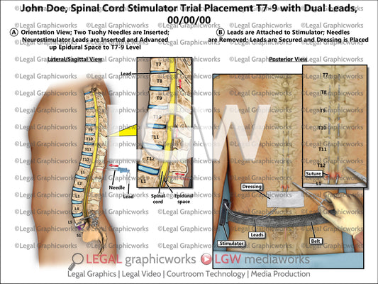 Spinal Cord Stimulator Trial Placement T7-9 with Dual Leads
