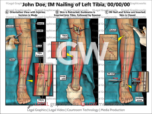 IM Nailing of Left Tibia