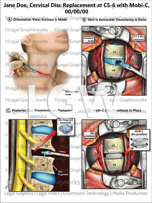 Cervical Disc Replacement at C5-6 with Mobi-C