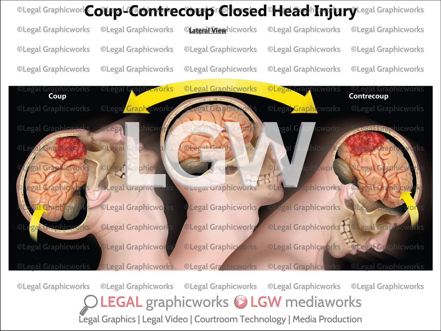 Coup-Contrecoup Closed Head Injury