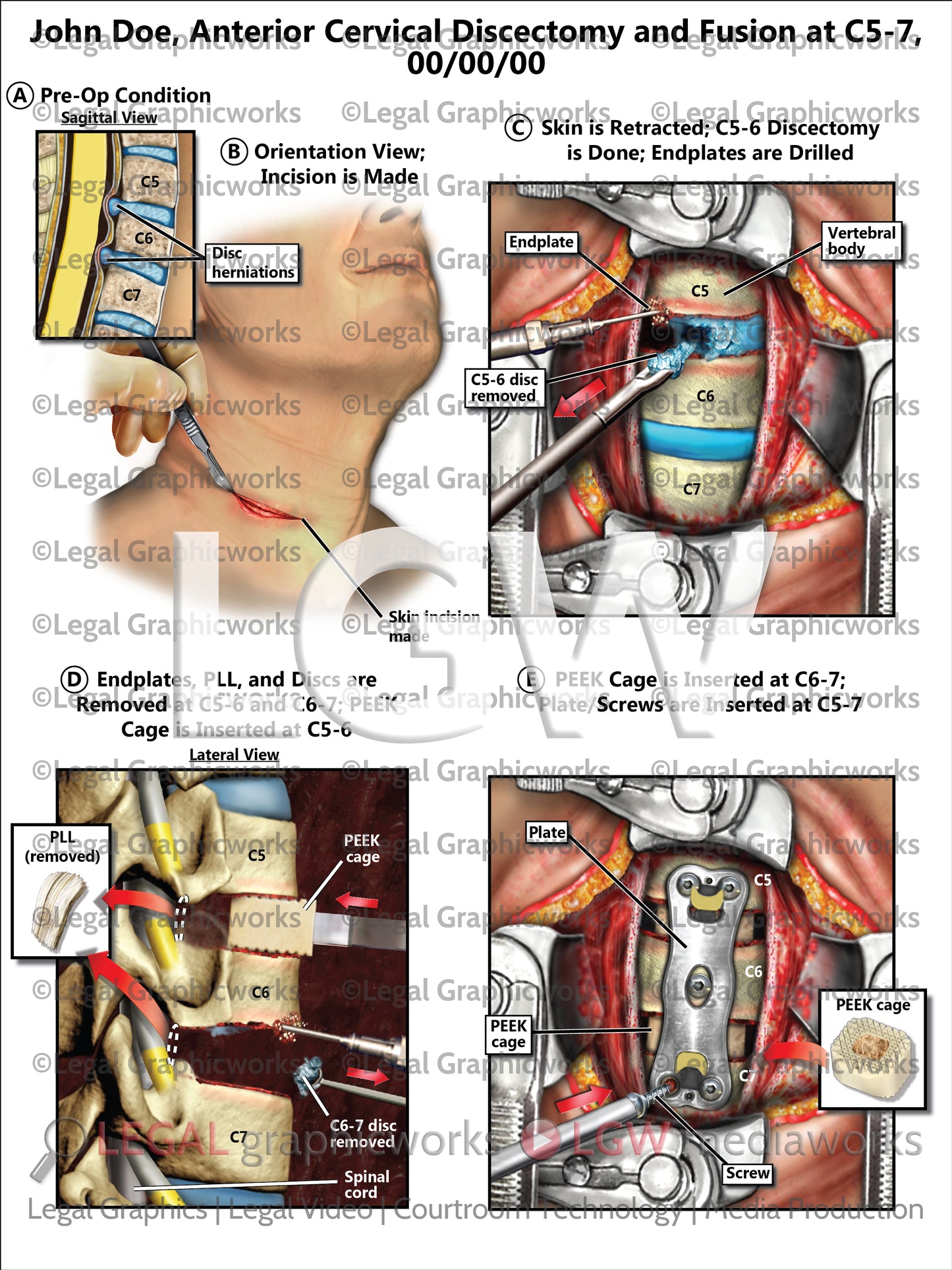 Anterior Cervical Discectomy and Fusion at C5-7