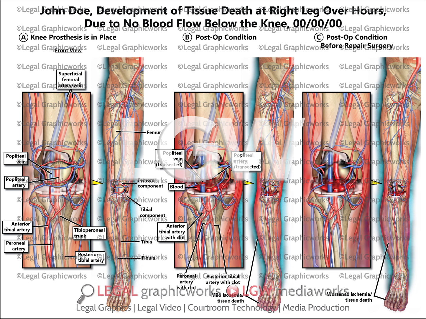 Development of Tissue Death at Right Leg Over Hours, Due to No Blood Flow Below the Knee