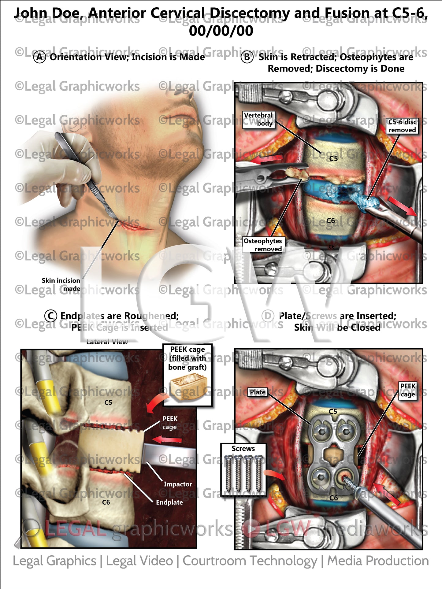 Anterior Cervical Discectomy and Fusion at C5-6